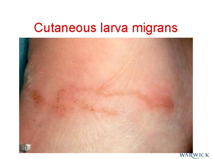 Cutaneous larva migrans Cutaneous larva migrans