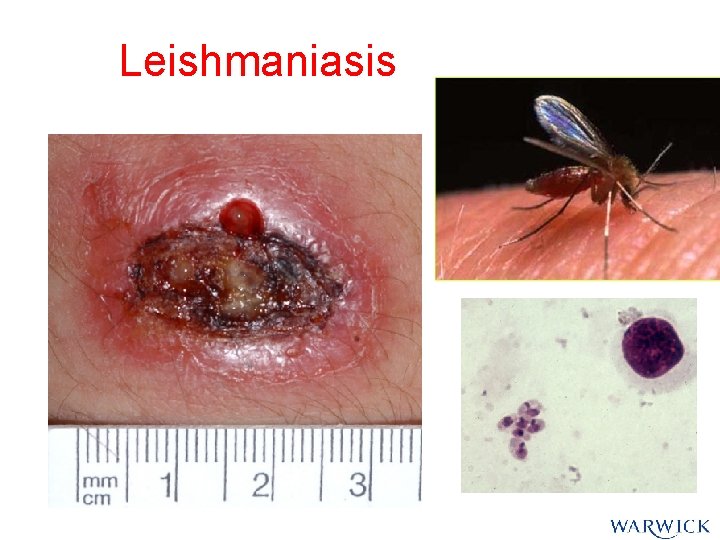 Leishmaniasis Leishmaniasis