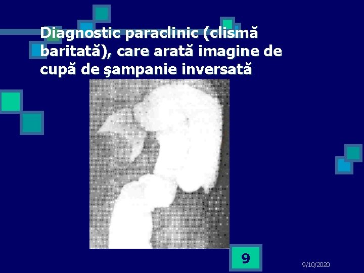 Diagnostic paraclinic (clismă baritată), care arată imagine de cupă de şampanie inversată 9 9/10/2020