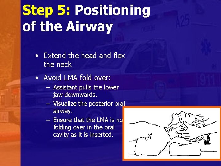 Step 5: Positioning of the Airway • Extend the head and flex the neck