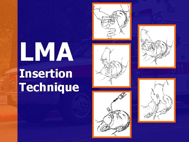 LMA Insertion Technique 