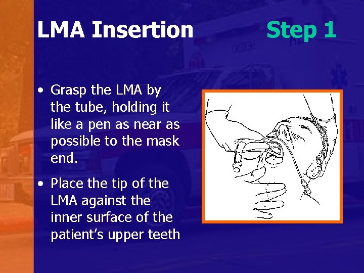 LMA Insertion • Grasp the LMA by the tube, holding it like a pen