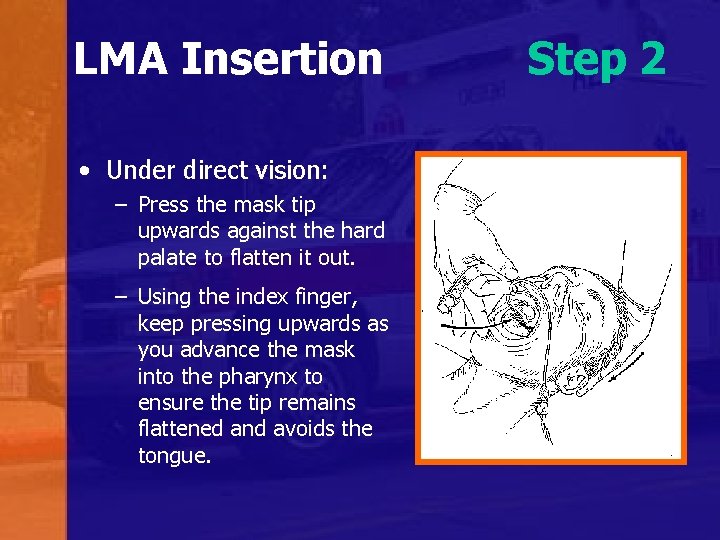 LMA Insertion • Under direct vision: – Press the mask tip upwards against the