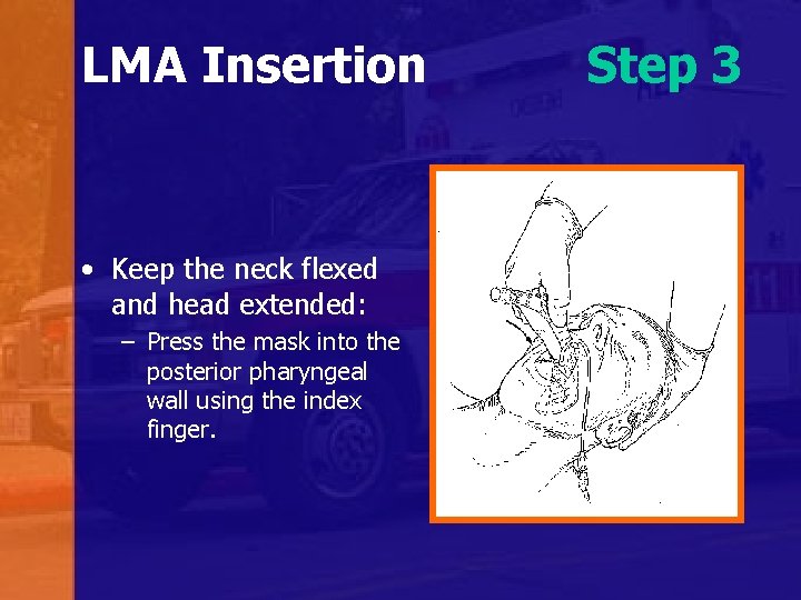 LMA Insertion • Keep the neck flexed and head extended: – Press the mask