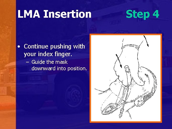 LMA Insertion • Continue pushing with your index finger. – Guide the mask downward