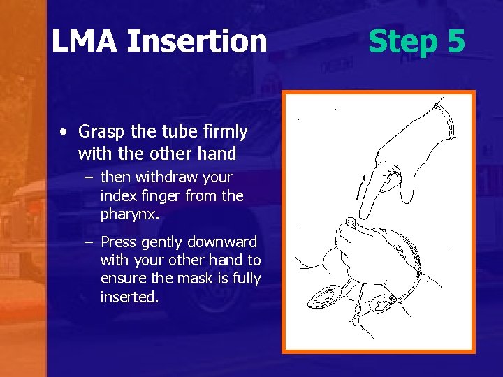 LMA Insertion • Grasp the tube firmly with the other hand – then withdraw