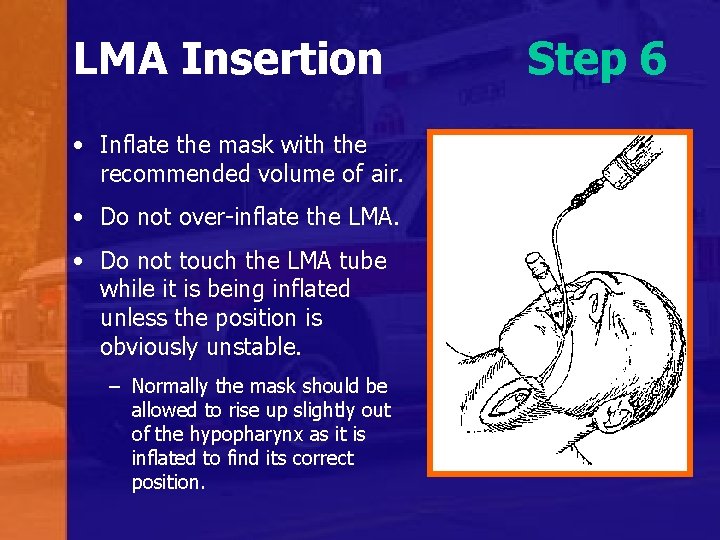 LMA Insertion • Inflate the mask with the recommended volume of air. • Do