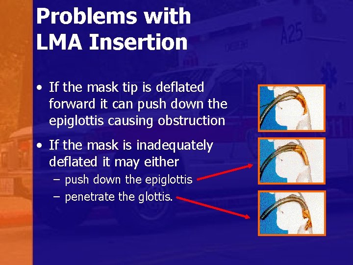 Problems with LMA Insertion • If the mask tip is deflated forward it can