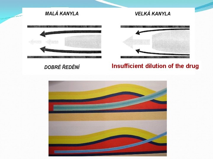 Insufficient dilution of the drug 