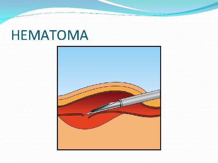 HEMATOMA 