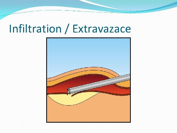 Infiltration / Extravazace 