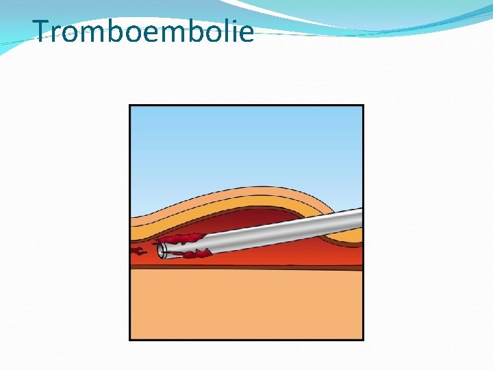 Tromboembolie 