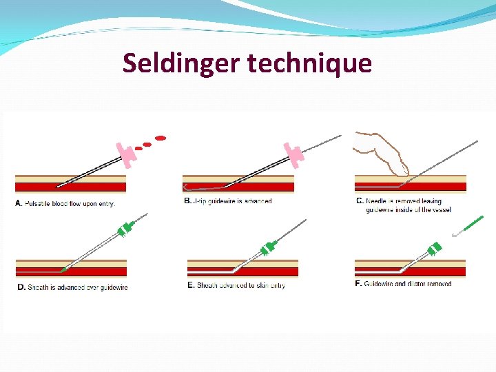 Seldinger technique 