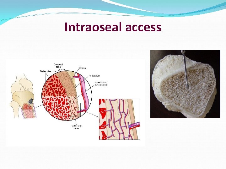 Intraoseal access 