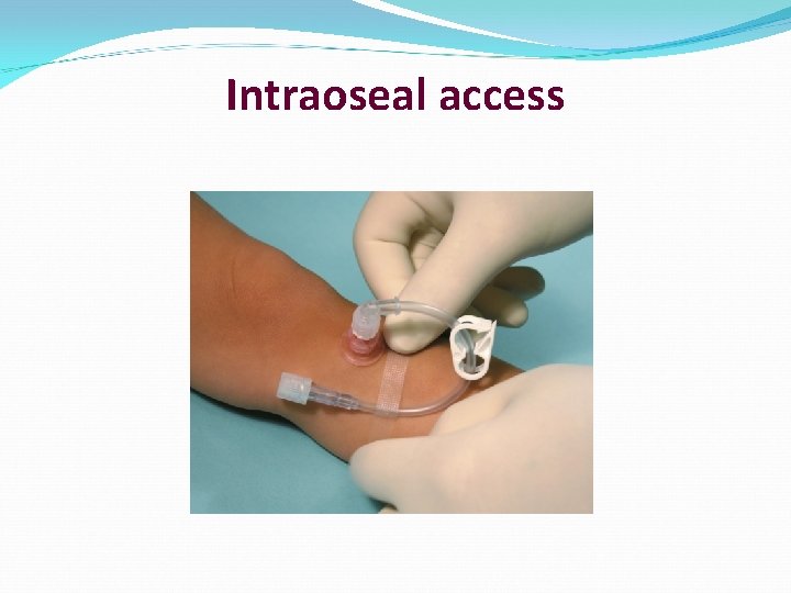 Intraoseal access 