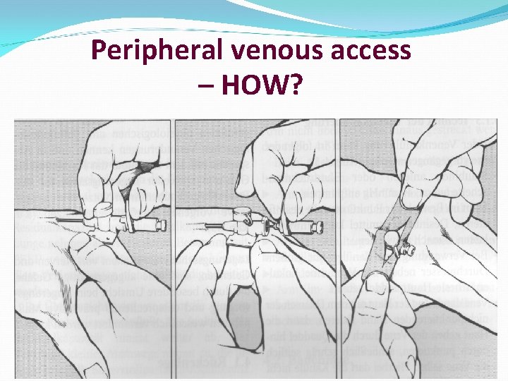 Peripheral venous access – HOW? 