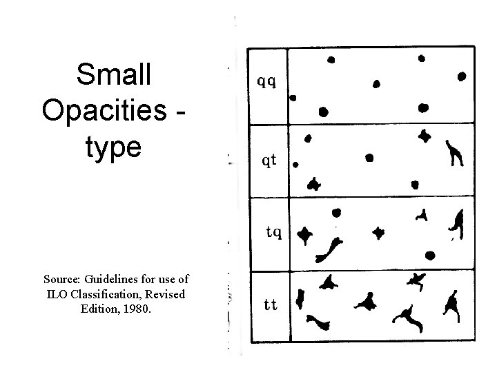 Small Opacities type Source: Guidelines for use of ILO Classification, Revised Edition, 1980. 