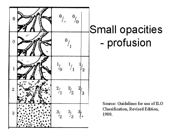 Small opacities - profusion Source: Guidelines for use of ILO Classification, Revised Edition, 1980.