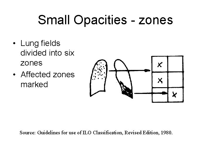Small Opacities - zones • Lung fields divided into six zones • Affected zones