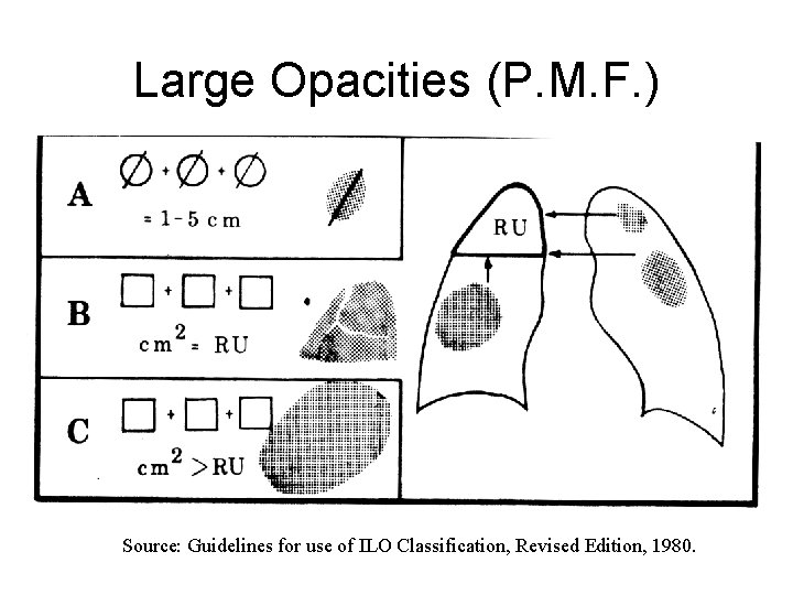 Large Opacities (P. M. F. ) Source: Guidelines for use of ILO Classification, Revised