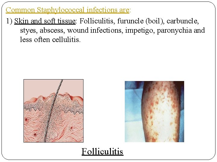 Common Staphylococcal infections are: 1) Skin and soft tissue: Folliculitis, furuncle (boil), carbuncle, styes,