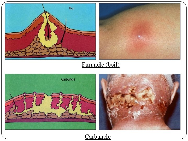 Furuncle (boil) Carbuncle 