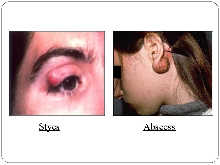 Styes Abscess 