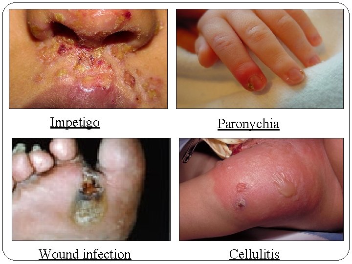 Impetigo Wound infection Paronychia Cellulitis 