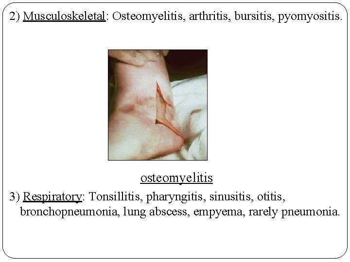 2) Musculoskeletal: Osteomyelitis, arthritis, bursitis, pyomyositis. osteomyelitis 3) Respiratory: Tonsillitis, pharyngitis, sinusitis, otitis, bronchopneumonia,