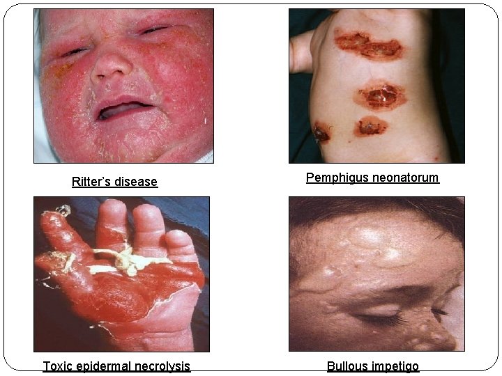 Ritter’s disease Pemphigus neonatorum Toxic epidermal necrolysis Bullous impetigo 