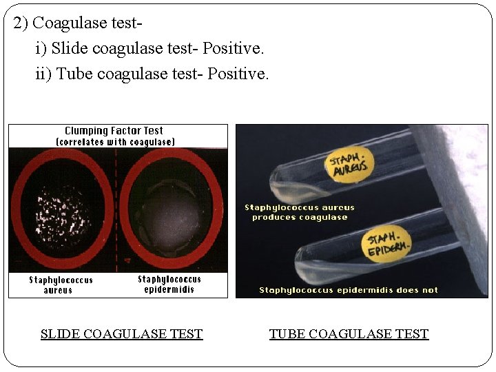 2) Coagulase testi) Slide coagulase test- Positive. ii) Tube coagulase test- Positive. SLIDE COAGULASE