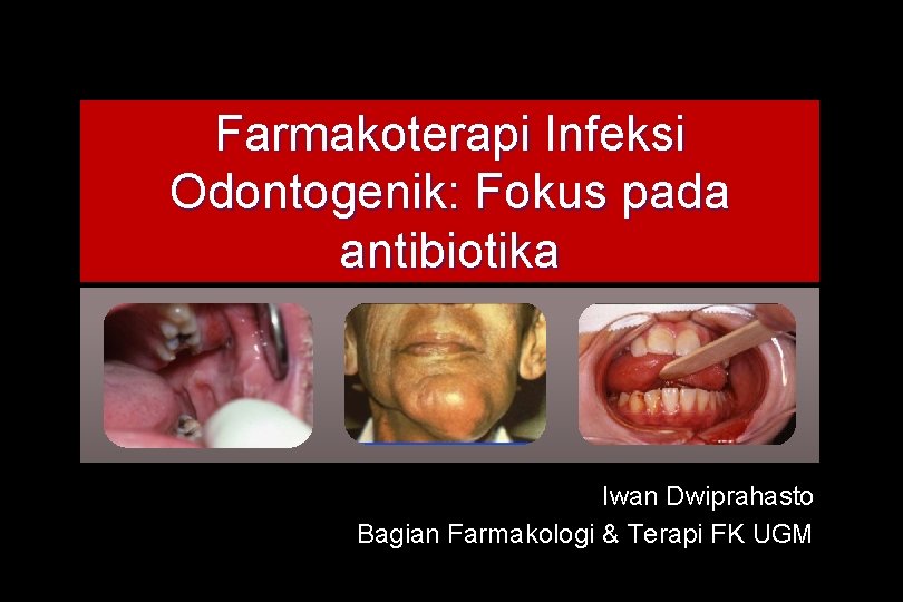 Farmakoterapi Infeksi Odontogenik: Fokus pada antibiotika Iwan Dwiprahasto Bagian Farmakologi & Terapi FK UGM