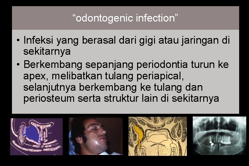 “odontogenic infection” • Infeksi yang berasal dari gigi atau jaringan di sekitarnya • Berkembang