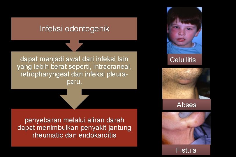 Infeksi odontogenik dapat menjadi awal dari infeksi lain yang lebih berat seperti, intracraneal, retropharyngeal
