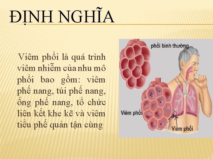 ĐỊNH NGHĨA Viêm phổi là quá trình viêm nhiễm của nhu mô phổi bao