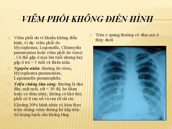 VIÊM PHỔI KHÔNG ĐIỂN HÌNH � � Viêm phổi do vi khuẩn không điển