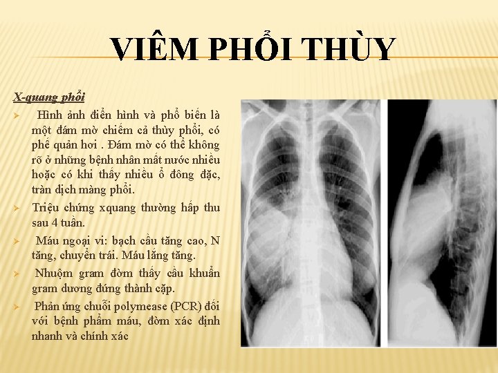 VIÊM PHỔI THÙY X-quang phổi Ø Hình ảnh điển hình và phổ biến là