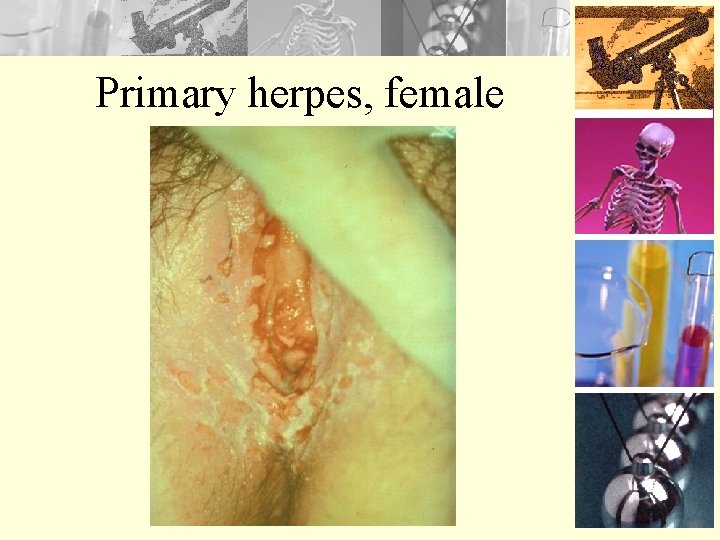 Primary herpes, female 