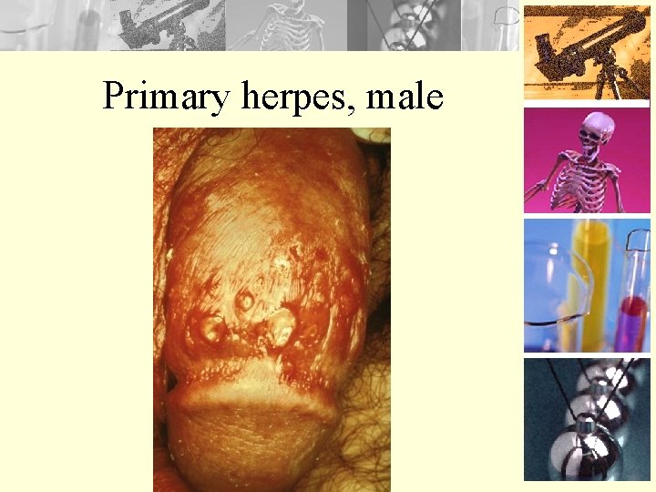 Primary herpes, male 