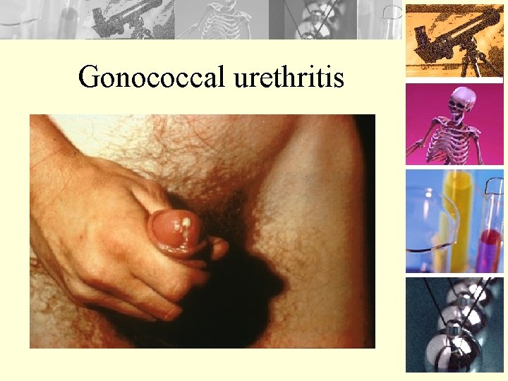 Gonococcal urethritis 
