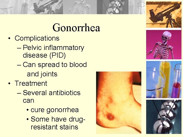 Gonorrhea • Complications – Pelvic inflammatory disease (PID) – Can spread to blood and