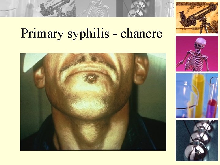 Primary syphilis - chancre 