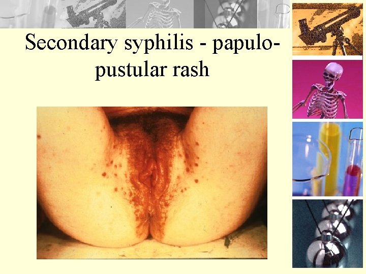 Secondary syphilis - papulopustular rash 