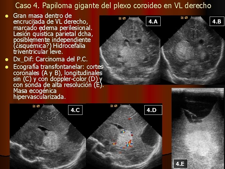 Caso 4. Papiloma gigante del plexo coroideo en VL derecho Gran masa dentro de