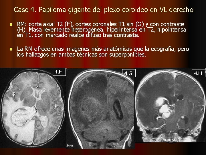 tumor papiloma de plexos coroideos)