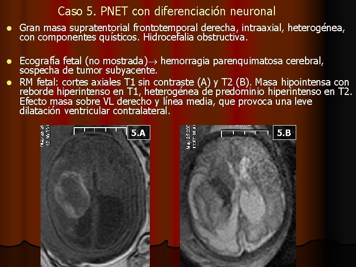 Caso 5. PNET con diferenciación neuronal l Gran masa supratentorial frontotemporal derecha, intraaxial, heterogénea,