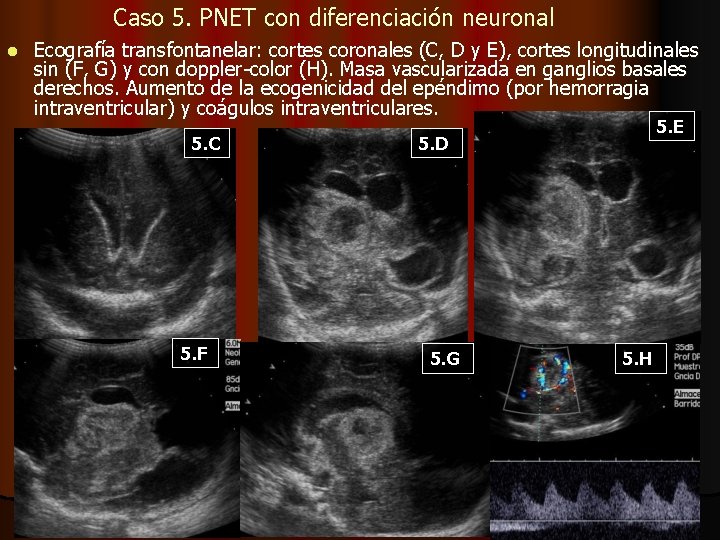 Caso 5. PNET con diferenciación neuronal l Ecografía transfontanelar: cortes coronales (C, D y