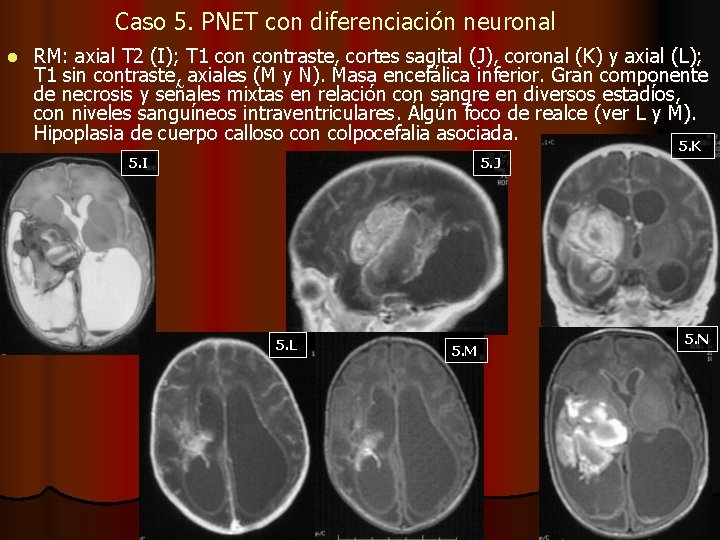 Caso 5. PNET con diferenciación neuronal l RM: axial T 2 (I); T 1