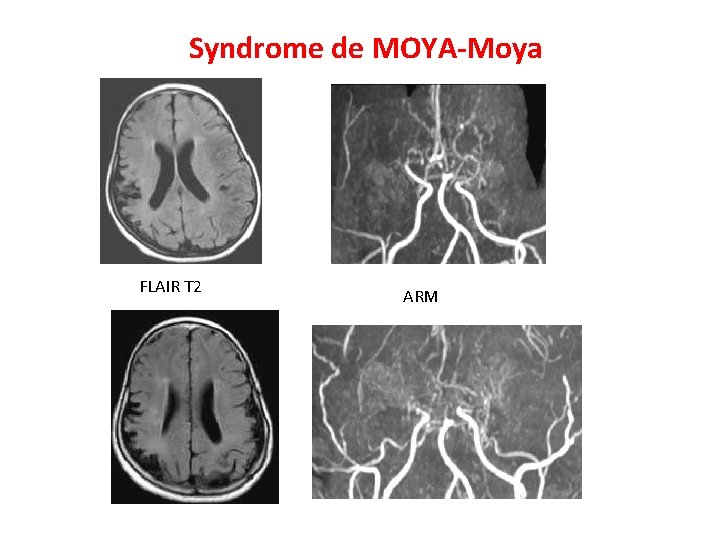 Syndrome de MOYA-Moya FLAIR T 2 ARM 