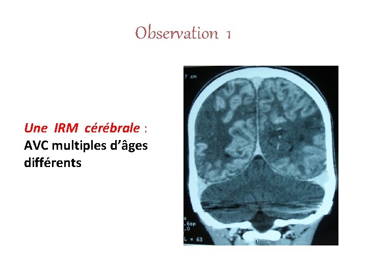 Observation 1 Une IRM cérébrale : AVC multiples d’âges différents 